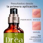 Gel dermolimpiador para piel con brotes e irritación recurrente