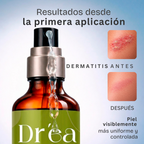 Gel dermolimpiador para piel con brotes e irritación recurrente